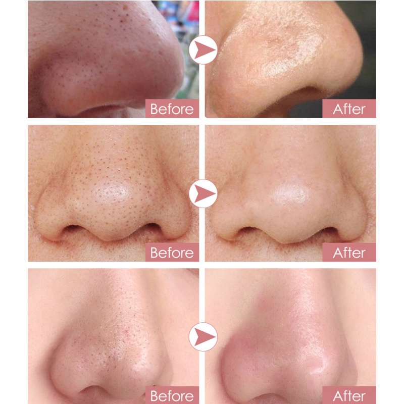 Mặt Nạ Lột Mụn Đầu Đen Kimuse Dưỡng Ẩm Làm Sạch Sâu