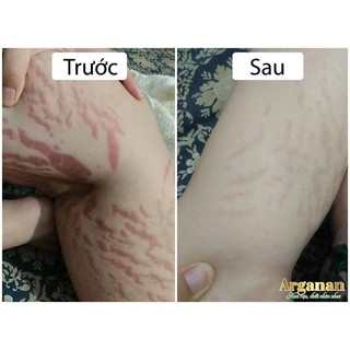 Dầu trị rạn Arganan (1 hộp)