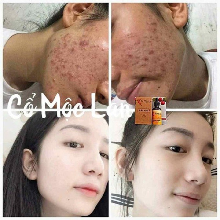 Cổ mộc lan tái tạo 20ml