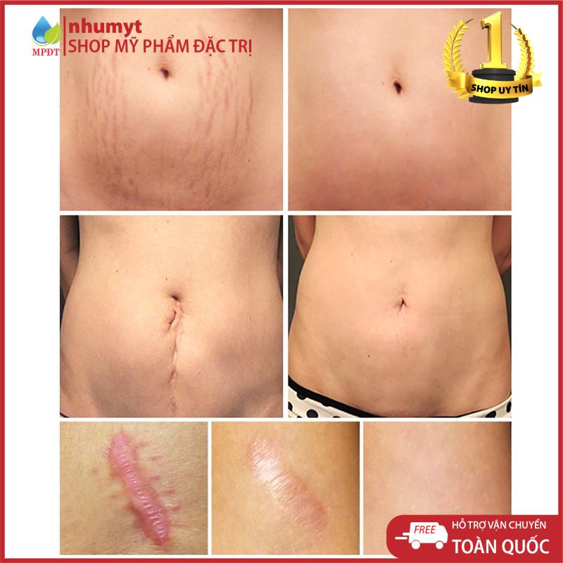 Kem mờ sẹo làm trắng da, mờ thâm sẹo | BigBuy360 - bigbuy360.vn