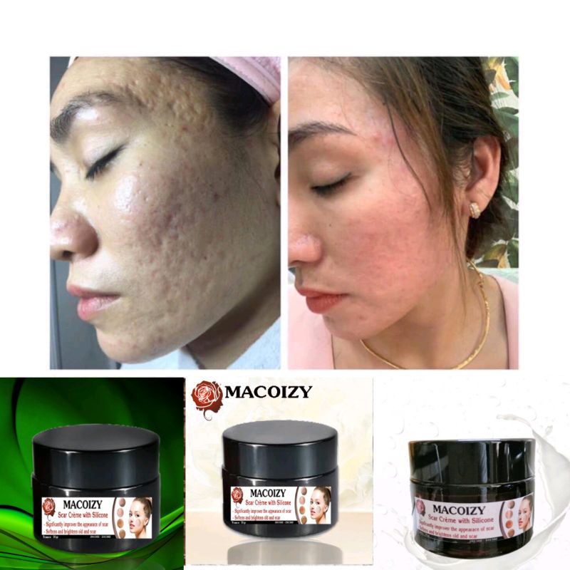 Kem Xóa Sẹo Rỗ Sẹo Mụn Sẹo Thâm