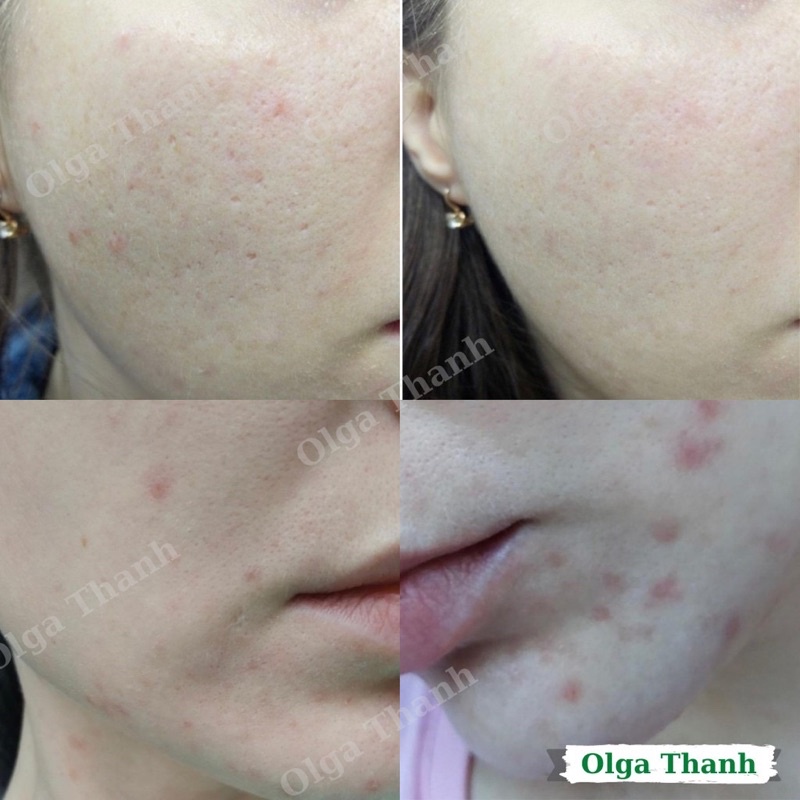 Serum Ten na  giảm sưng viêm, kiềm dầu