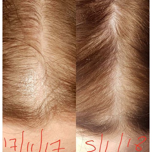 Dung Dịch Mọc Tóc - Mọc Lông Vùng Kín Nữ Minoxidil Basic Care 5% Dạng Bọt