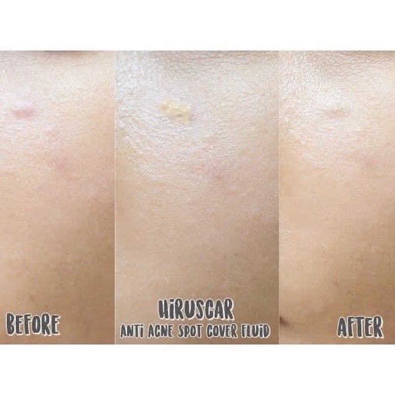 Bút che khuyết điểm ngừa mụ.n Hirucas Anti-Ance Spot Cover Fluid