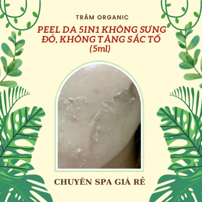 Peel 5 in 1 không sưng đỏ, không tăng sắc tố