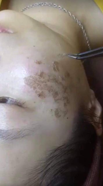 Chấm nám chấm tàn nhang