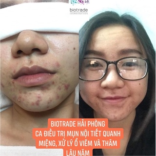 Kem Chấm Mụn - Active Cream 30ml