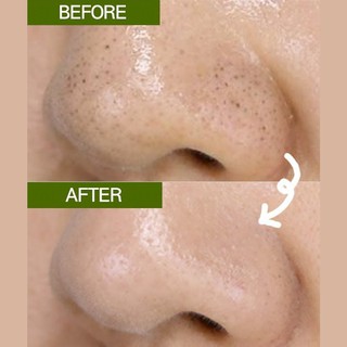 Lăn trị mụn đầu đen Mamonde