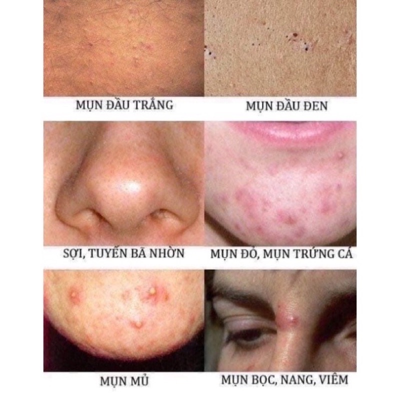 Kem mụn v-nice sạch mụn sáng da mờ thâm giúp tái tạo da trắng sáng