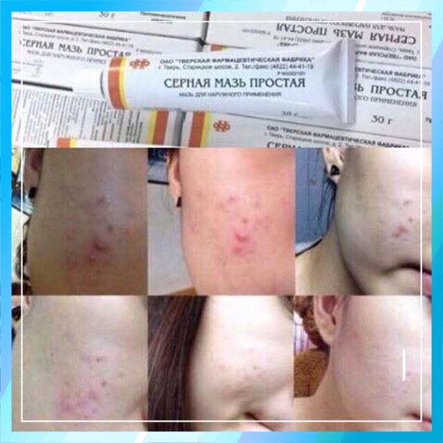 Kem ngăn ngừa mụn, hạn chế mụn lưu huỳnh Cephar Nga (tuýp 30g) | BigBuy360 - bigbuy360.vn