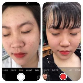 3 hũ nhỏ kem mụn