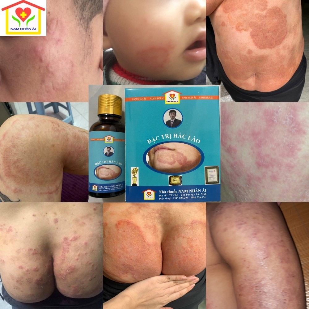 Hắc lào, nấm bẹn dứt điểm Đông Y gia truyền Ông Lam | BigBuy360 - bigbuy360.vn