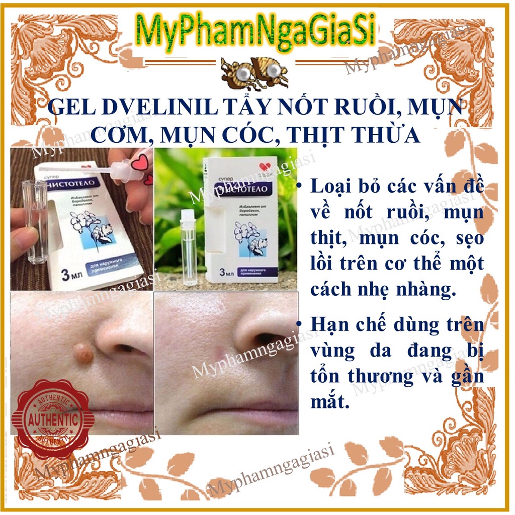 GEL TẨY NỐT RUỒI, MỤN CƠM, MỤN CÓC, THỊT THỪA Nga