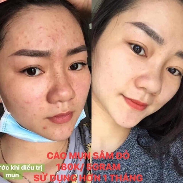 36VỊ - CAO MỤN SÂM ĐỎ 15GR | BigBuy360 - bigbuy360.vn