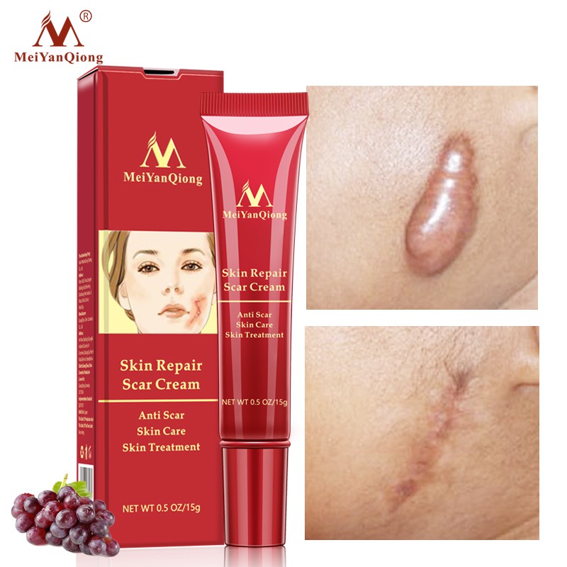 MeiYanQiong Acne Scar Removal Cream Skin Repair Stretch Marks giảm sẹo lồi, lõm, sẹo thâm, do mụn giúp phục hồi các tổn thương trên da thúc đẩy tái tạo da 15ml