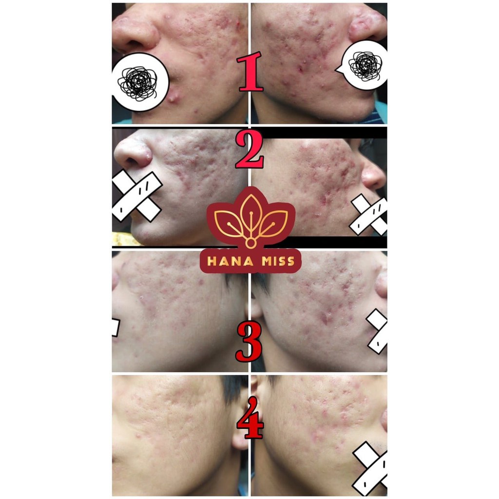 Serum mụn Hana Miss ⚡100% KHỎI MỤN⚡ xóa thâm sạm nám tái tạo da | BigBuy360 - bigbuy360.vn