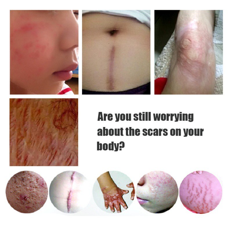 Kem Hỗ trợ giảm sẹo Làm Sáng Da Loại Bỏ Melanin 20ML