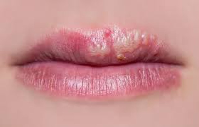 MIẾNG DÁN ĐIỀU TRỊ MỤN RỘP (HERPES) MÔI | BigBuy360 - bigbuy360.vn