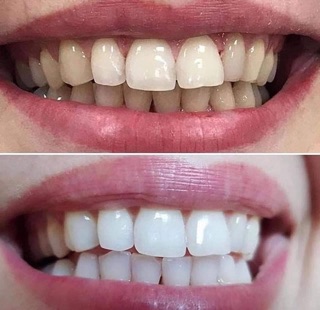 Miếng dán trắng răng Cresst 3D White Mỹ