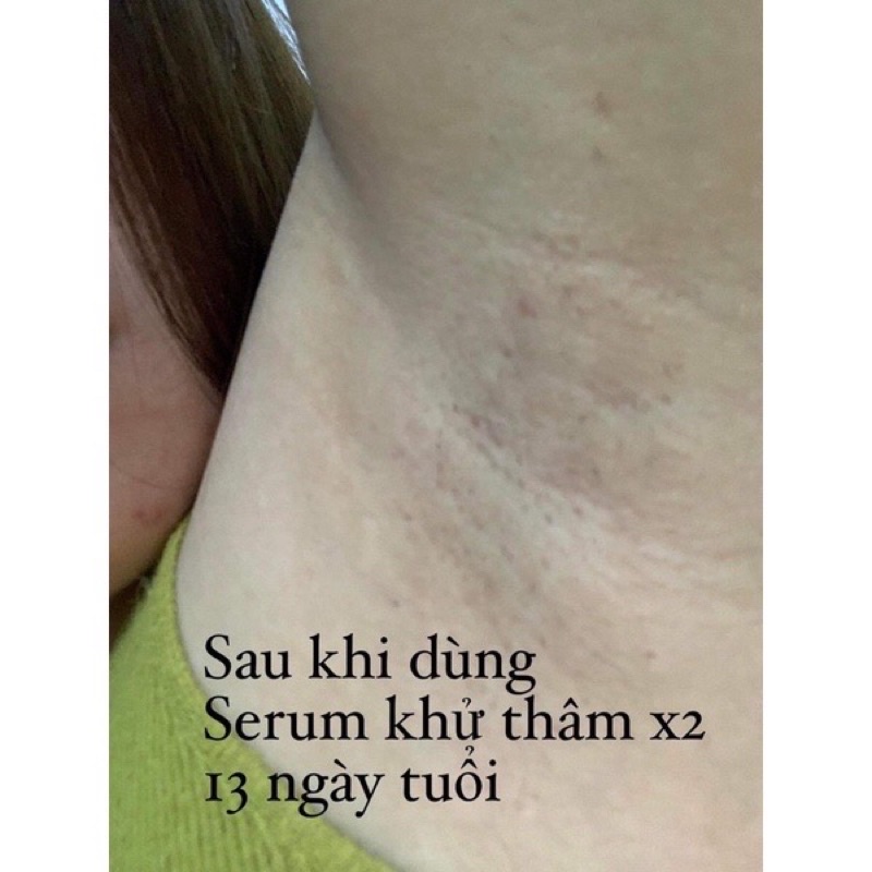 Serum xoá thâm X2 Huyền Phi 20ml