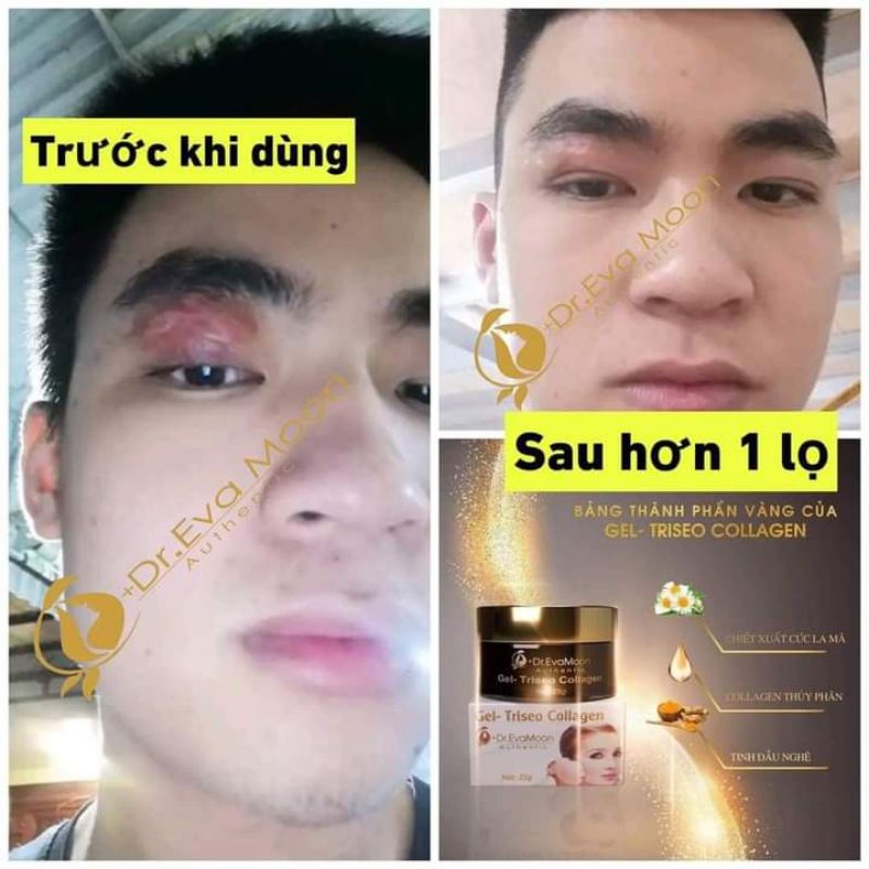 Gel sẹo collagen Dr Eva Mom 25g. Tặng kèm 10 bông tẩy trang