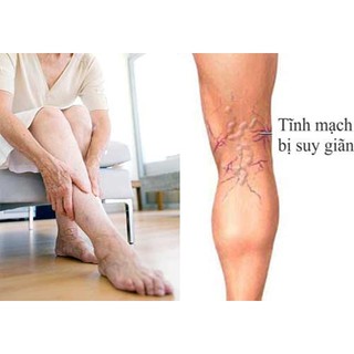 Máy điều trị suy giãn tĩnh mạch chi