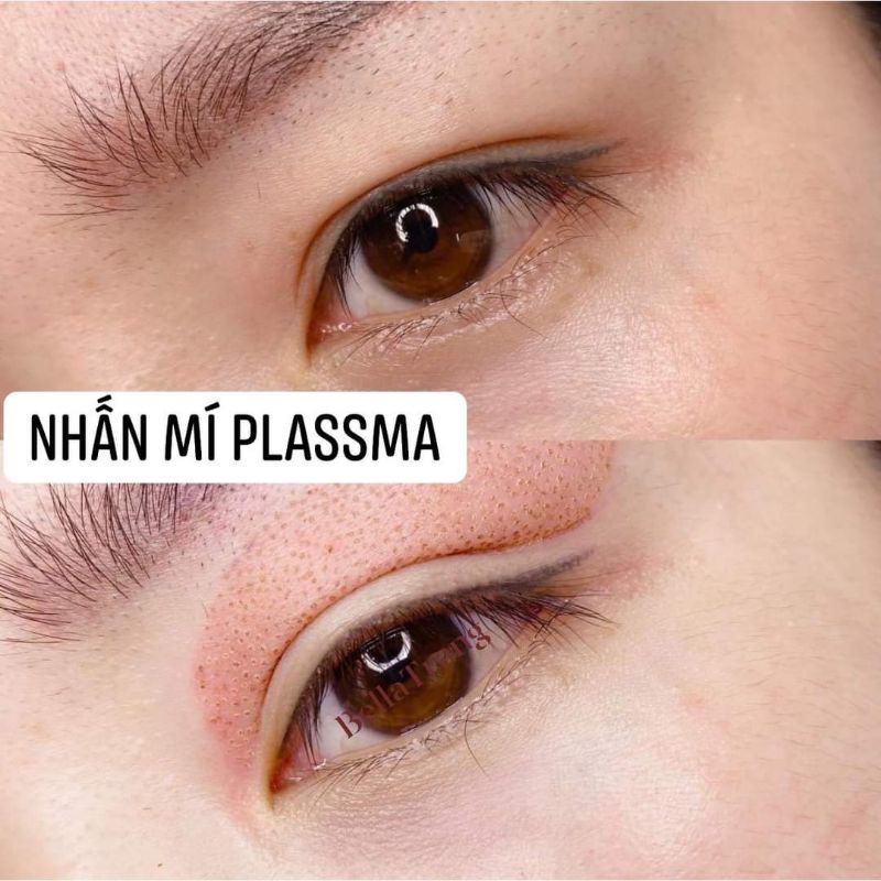 Máy Plassma BEAUTY MONSTER Chính Hãng Hàn Quốc