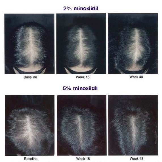 Xịt Giảm Rụng Tóc, Ngăn Rụng Tóc, Kích Thích Mọc Tóc Minoxidil Bailleul 5% và Minoxidil Bailleul 2%