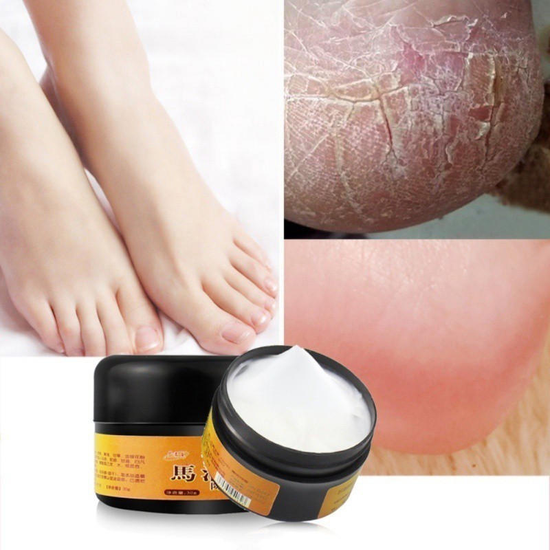 Kem hỗ trợ giảm nứt nẻ gót chân từ mỡ ngựa giữ ẩm và cải thiện da