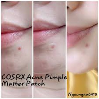 Miếng dán mụn Cosrx
