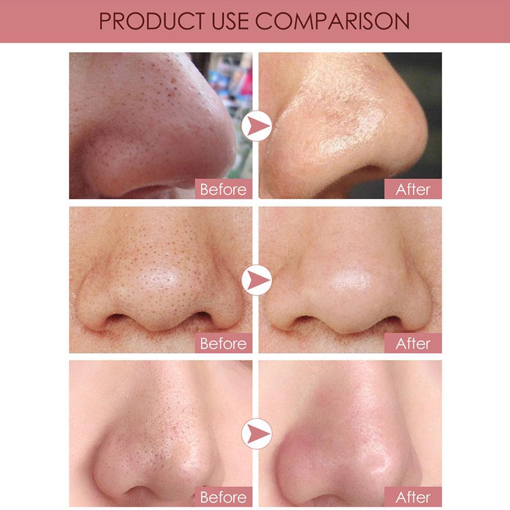 Miếng dán lột mụn đầu đen kiểm soát dầu làm sạch da mặt L6J0 | BigBuy360 - bigbuy360.vn