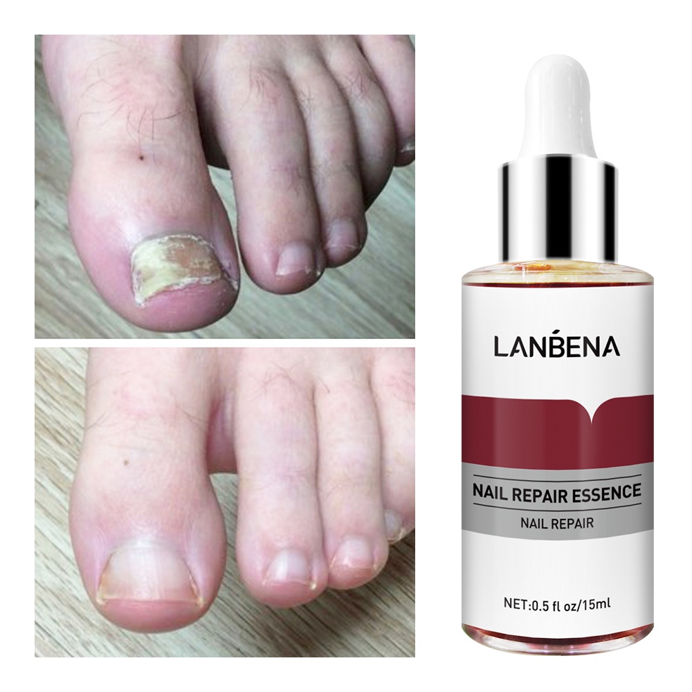 Tinh Chất Lanbena Hỗ Trợ Giảm Bệnh Nấm Móng 15Ml- Vibesvietnam