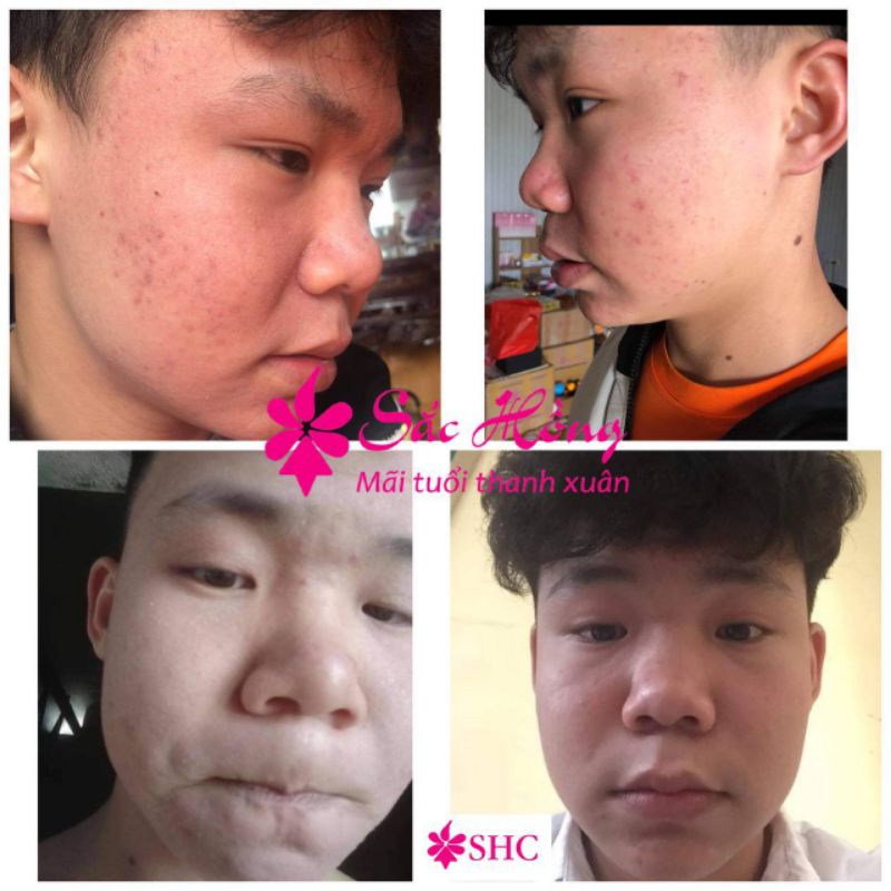 Tinh chất loại bỏ mụn - mờ nám Sắc Hồng 50ml - kiềm dầu - đều màu da - mờ thâm