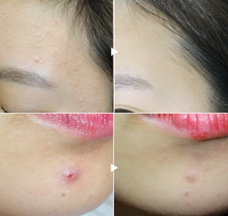 TRỊ MỤN VIÊM BENZAC 5 ( BENZOYL PEROXIDE )
