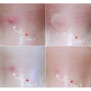 Miếng Dán Mụn Cosrx Acne Pimple Master Patch 24 Miếng Acne Pimple Master Patch