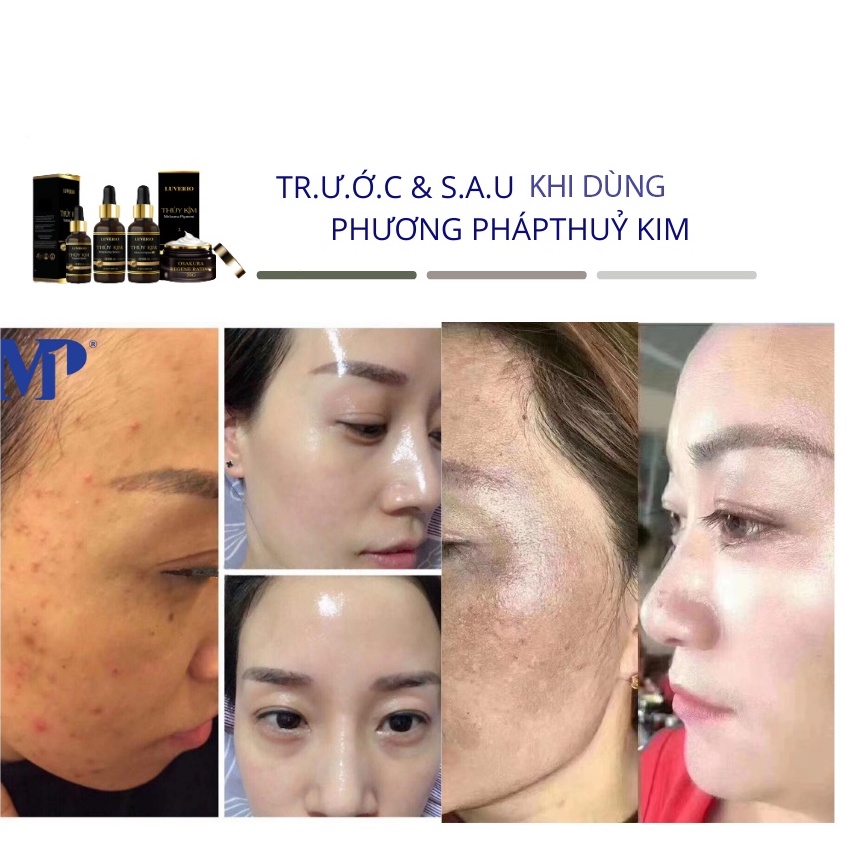 Thủy Kim Số 2 - Tinh Chất Nám Mụn Osakura Herbal 02 - Luverio Thuỷ Kim 2