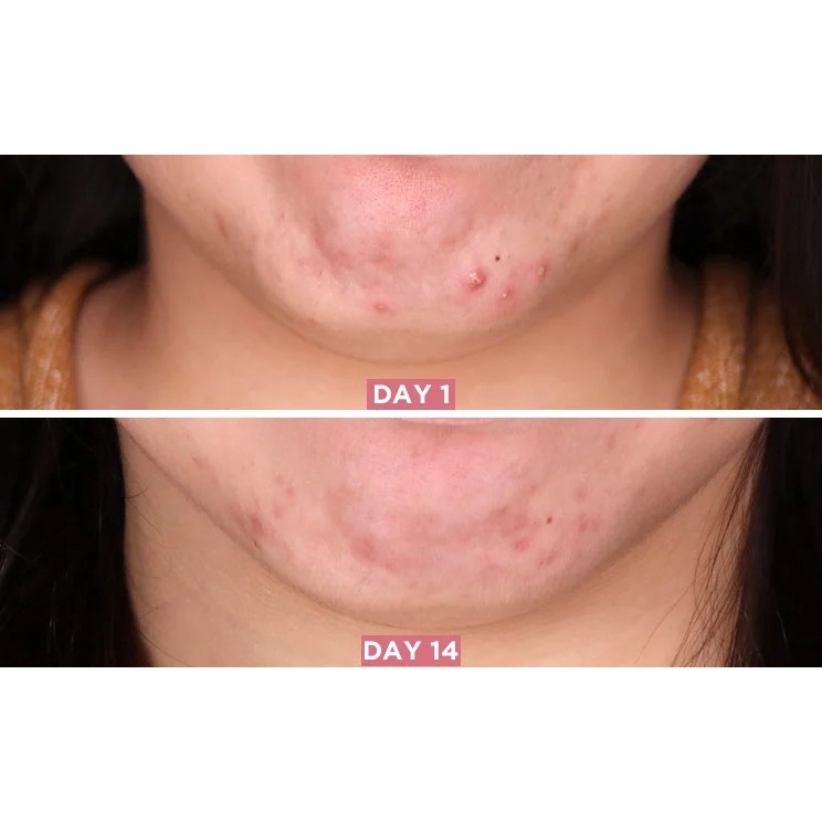 Tinh Chất Some By Mi AHA BHA PHA Giảm Mụn Mờ Thâm Sau 30 Ngày Miracle Serum - 50ml