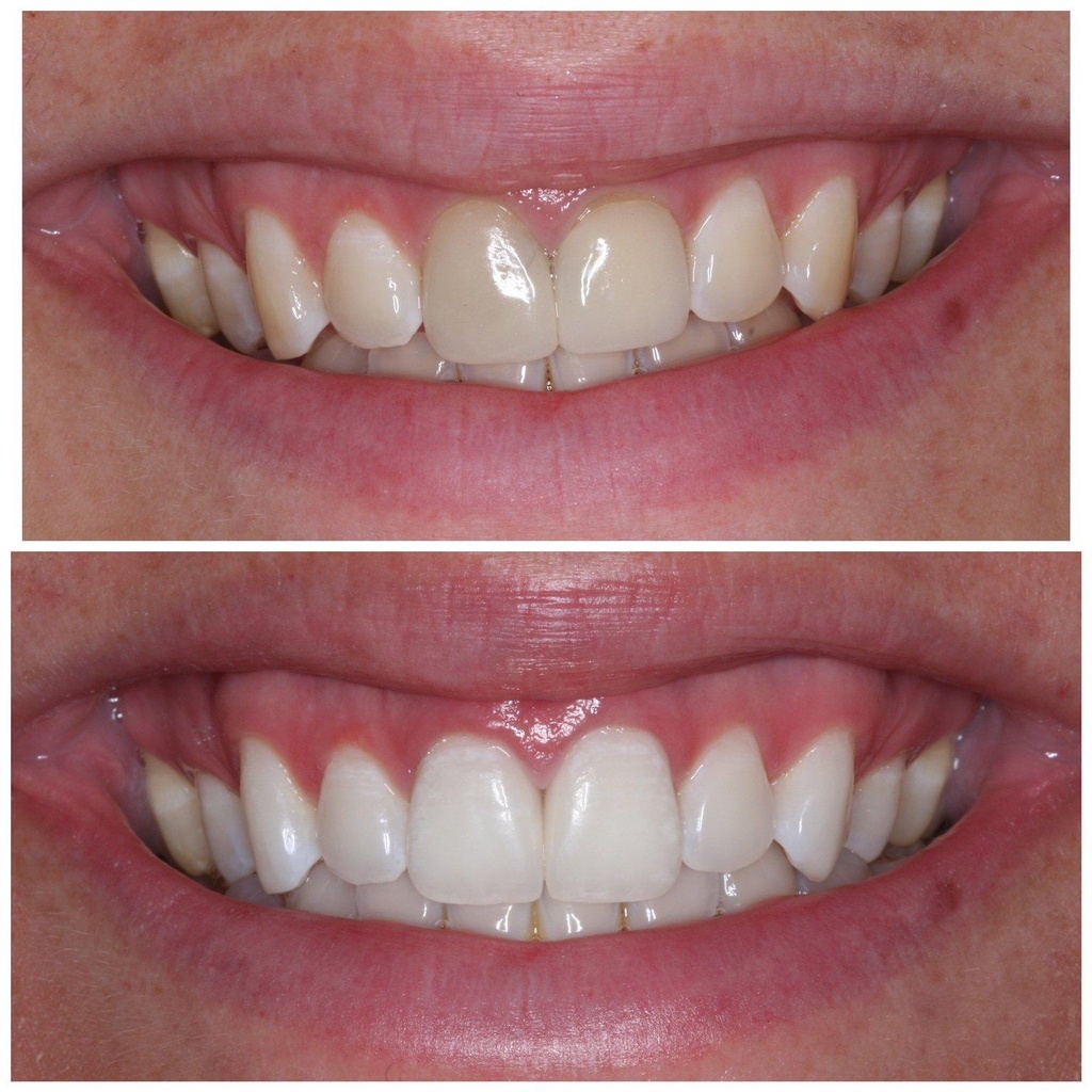 Kem đánh răng làm trắng răng Eucryl Toothpaste 62g