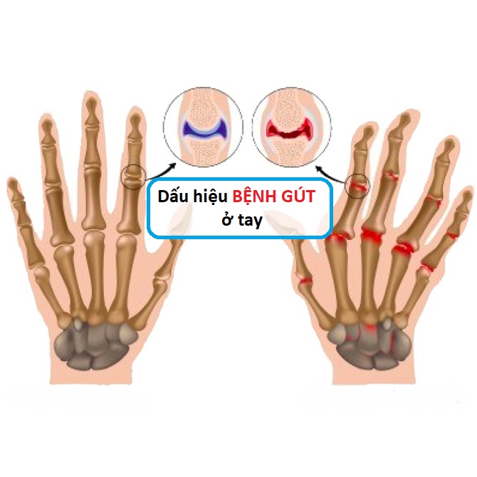 Viên Uống Hỗ Trợ Điều Trị Bệnh Gout Anserine Minami