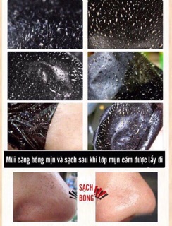 Lột mụn than tre