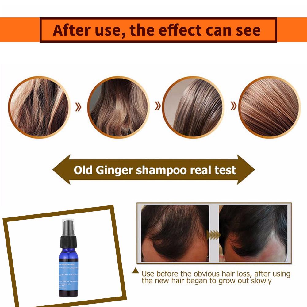 Tinh dầu chống mất kích thích mọc tóc 30ml