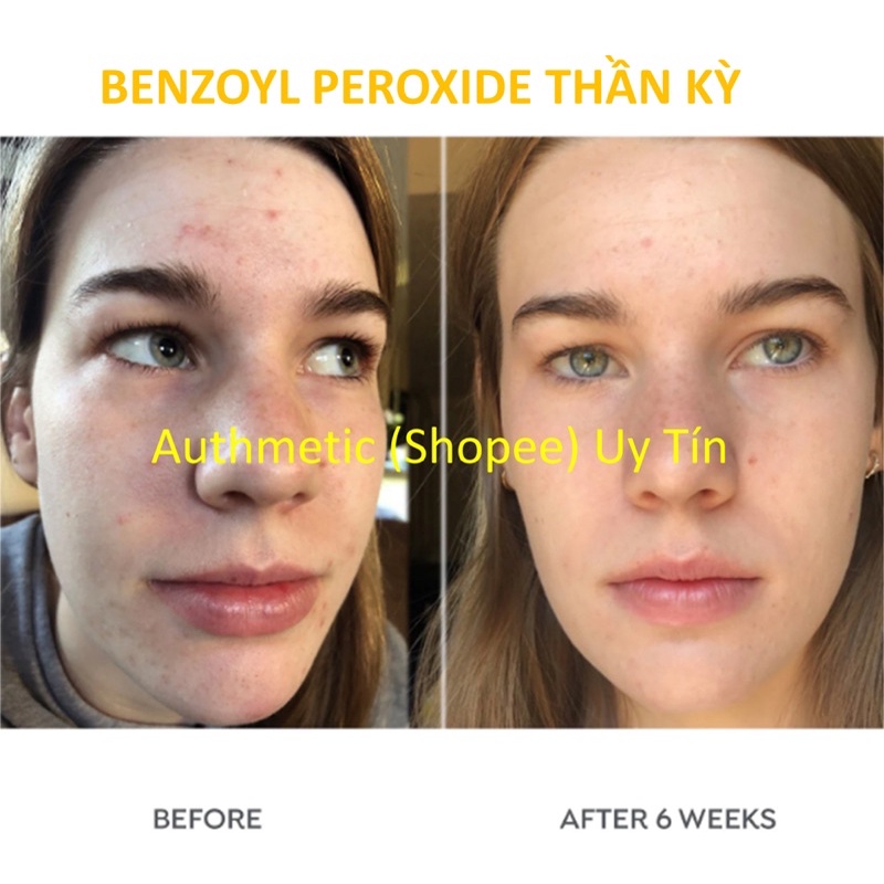 Benzac AC Benzoyl Peroxide 2.5/5/10% bay mụn giảm viêm da nhẵn nhụi