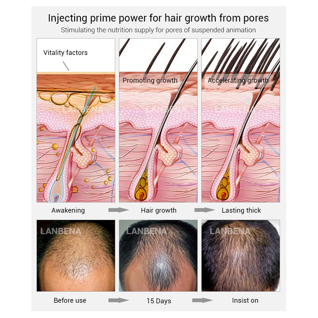 Tinh Chất Xịt Dưỡng Tóc LANBENA Chăm Sóc Gốc Tóc Chống Rụng Chống Hói Đầu 20ml | BigBuy360 - bigbuy360.vn