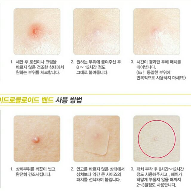 Miếng dán  mụn Hàn Quốc Haley cải tiến 20-40-80 miếng | BigBuy360 - bigbuy360.vn