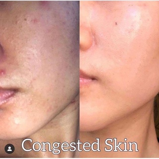 Serum The Ordinary – AHA 30% + BHA 2% Peeling Solution