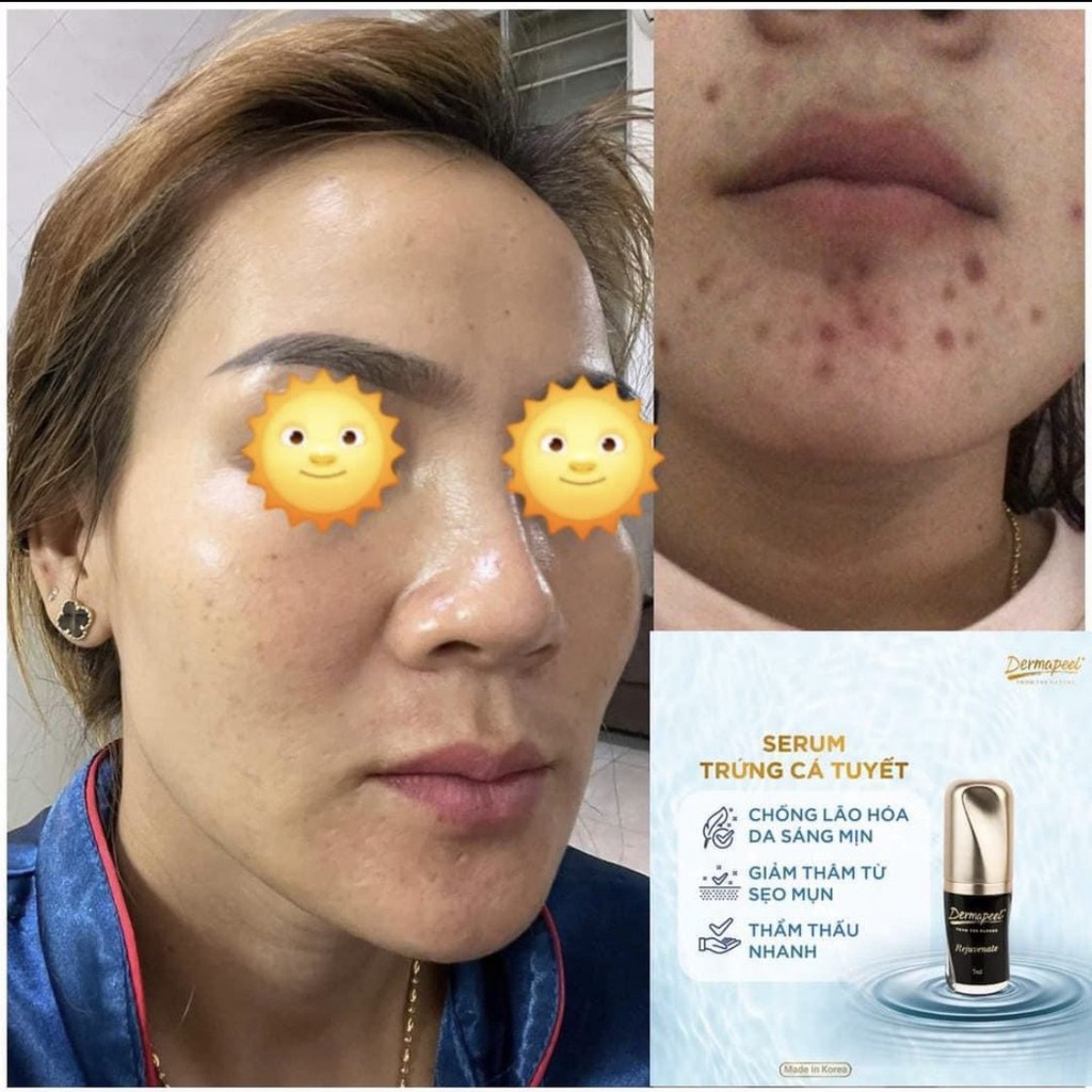 SERUM TRỨNG CÁ TUYẾT Dermapeel+ - XÓA MỤN - Mờ THÂM MỤN - Se Khít LCL - DA CĂNG BÓNG - TRẮNG SÁNG SAU 14 NGÀY | BigBuy360 - bigbuy360.vn