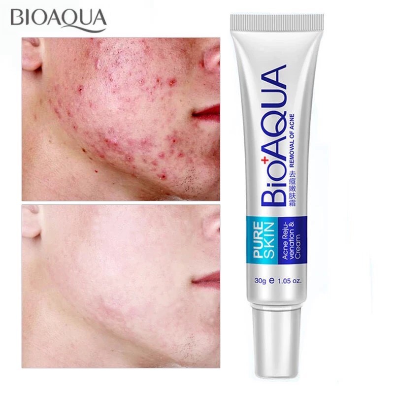 Kem Bôi Mụn PURE SKIN Bioaqua  Chăm Sóc Sắc Mặt Dưỡng da Hạn Chế Mụn Giảm Viêm Dưỡng Da Mỹ Phẩm Hana Nội Địa Trung