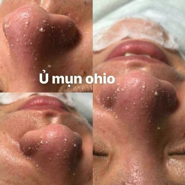 ủ mụn ohio