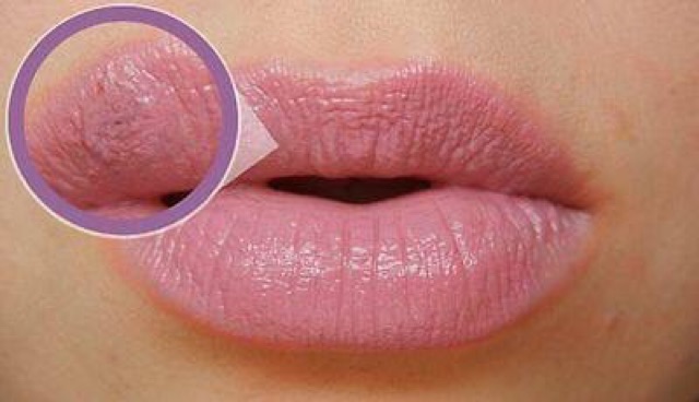 🇩🇪 Miếng dán trị giời leo / Herpes