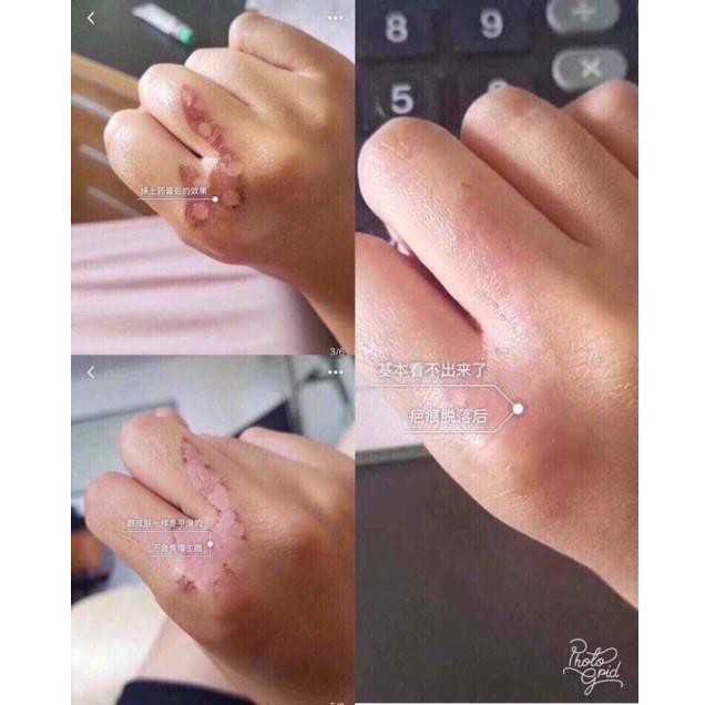 Trị sẹo Gentacin Nhật bản